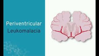 PVL Periventricular leukomalacia mrcpch Communication [upl. by Gmur926]