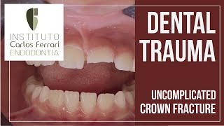 Dental Trauma Uncomplicated crown fracture [upl. by Timmy]