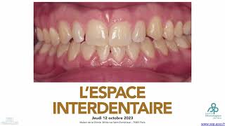 « Les aspects fondamentaux » sur lespace interdentaire ou interproximal [upl. by Airotkciv]