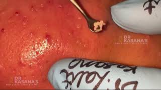 Deep old Blackheads Removal with Extrctor  Dr Lalit Kasana Skin Treatment [upl. by Kitarp]