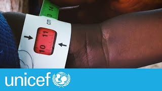 A simple tool to detect severe malnutrition the MUAC tape [upl. by Gawlas699]