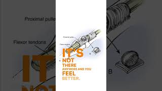 Intro to Retinacular Cysts of the Hand retinacularcysts handcysts handbumps handproblems [upl. by Leik251]