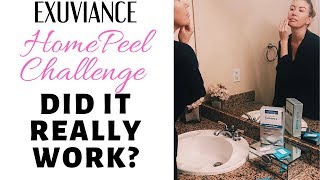 Do At Home Peels REALLY Work My Exuviance Peel Results [upl. by Tate]