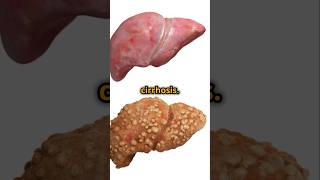 Top Causes of Liver Cirrhosis You Should Know shortvideo shortsviral shorts [upl. by Amitak]