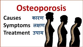 Osteoporosis Causes Symptoms Treatment Prevention Risk factore  Osteoporosis [upl. by Aihsel256]