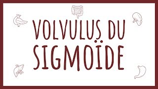 Sémiologie Chirurgicale  Volvulus du Sigmoïde [upl. by Llemij896]