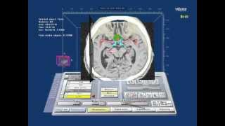 Virtual Reality planning of skull base surgery Tuberculum sellae meningioma [upl. by Nylarad]