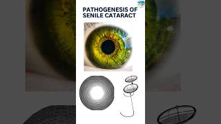 Stages and pathogenesis Of Senile Cataract cataract eye eyediseases [upl. by Deb]