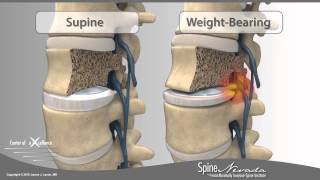 Weight bearing MRI provides optimal diagnosis of lumbar disc herniation  Reno Sparks Carson [upl. by Nalak]