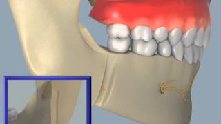 Sagittal Split Osteotomy [upl. by Annawek]