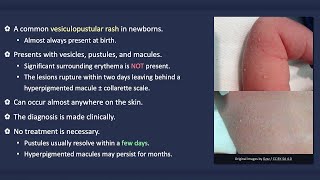 Transient Neonatal Pustular Melanosis [upl. by Yahsal]