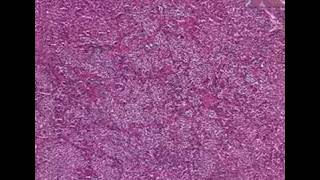 Histopathology PituitaryAcidophilic adenoma [upl. by Hoffer]