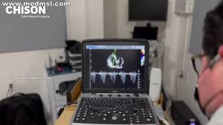 Chison SonoBook 9 is used in Cardiovascular Phased Probe Cardiac Video [upl. by Teresina]