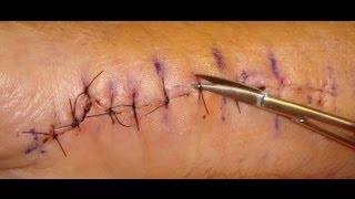 Suture Removal Protocol [upl. by Rabiah]