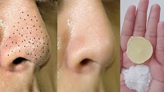 How to remove blackheads and whiteheads permanently  White heads and blackhead removal cream [upl. by Saw]