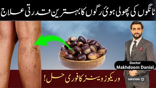 Best Remedy for Varicose Veins  ٹانگوں کی پھولی ہوئ رگوں کا بہترین قدرتی علاج [upl. by Zenda]