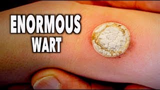 ENORMOUS WART vs LIQUID NITROGEN like seriously big  Dr Paul [upl. by Sykleb]