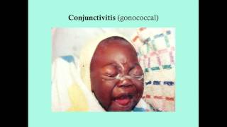 Conjunctivitis  CRASH Medical Review Series [upl. by Aynav]