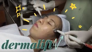 Dermalift Treatment [upl. by Malley]