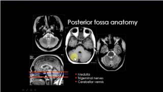 posterior cranial fossa anatomy in MRICT [upl. by Attenyw]