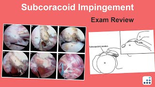 Subcoracoid Impingement Exam Review  Jay Keener MD [upl. by Deane]