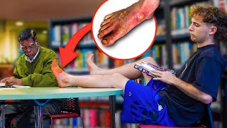 INFECTED FOOT PRANK [upl. by Adest]