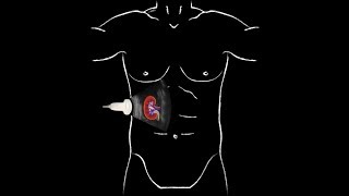 POCUS  Basic Renal Ultrasound [upl. by Paquito]