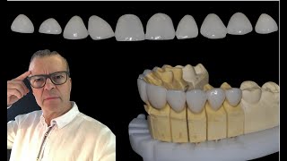 Prótese Dentária facetas de porcelana [upl. by Yzzo]