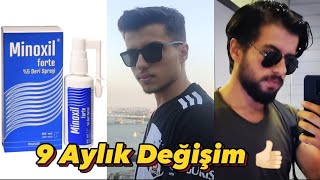 Minoxil Forte 5 Sakal Çıkarıyor Mu  9 Aylık Tecrübem [upl. by Gawlas]