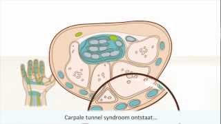 Carpale tunnel syndroom CTS  symptomen en behandeling [upl. by Siugram]