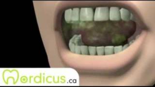 Consequences of malocclusion  Dental patient education [upl. by Yewed]