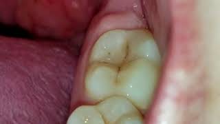 Tonsil stone removal BLOODY WARNING GRAPHIC CONTENT IN VIDEO [upl. by Adelaida523]