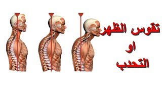 تمارين علاجية للتخلص من تقوس الظهر او التحدب Correct Hunchback [upl. by Domph]