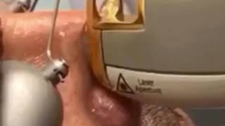 Nose Veins Laser Removal [upl. by Dacie]