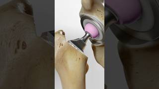 Total hip replacement explained 3D Animation [upl. by Warp218]