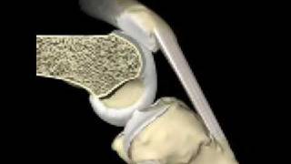 Patellofemoral joint motion and patellar tracking [upl. by Levina653]