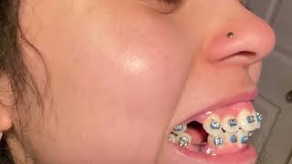 I GOT FOUR PREMOLAR EXTRACTIONS  Braces Update braces extractions adultbraces teeth vlog [upl. by Mann]