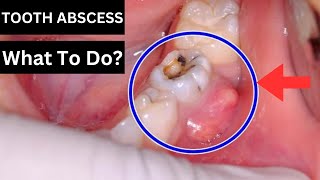 How To Treat A Tooth Abscess [upl. by Lledrev]