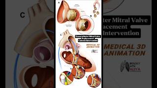 Transcatheter Mitral Valve Replacement  Caisson Intervention medical animation 3d short [upl. by Aramo]