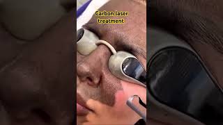 Carbon laser treatment [upl. by Acinej]