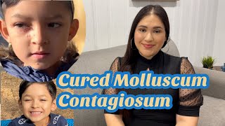 How we curedtreated molluscum contagiosum update 2021  How to get rid of molluscum contagiosum [upl. by Goode]