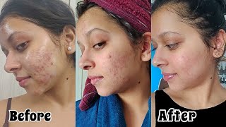 HOW I CLEARED MY ACNE  My Acne to Clear Skin Journey with Pictures  ProductsTreatment [upl. by Adonis]