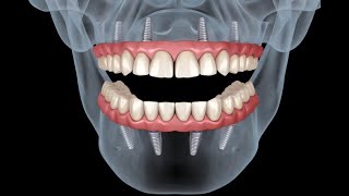 Implantes Multiples mediante Cirugia Guiada 3D  Multiple Implants through 3D Guided Surgery [upl. by Delahk854]