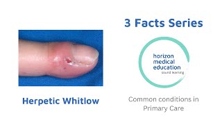 Herpetic whitlow  Finger infections  painful red finger  3facts [upl. by Kenweigh]