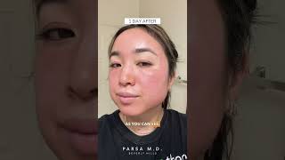 Cosmelan Peel Application and Results  Sun Spots Acne Scars and Hyperpigmentation [upl. by Fahey]