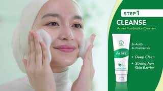 Acnes 3 Simple Steps to AcneFree Skin [upl. by Martinic204]