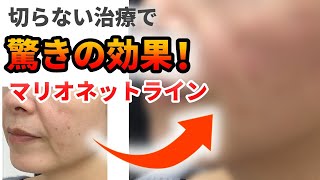 【マリオネットライン】切らずに改善したいあなたへ美容皮膚科医が解説 [upl. by Enajharas216]