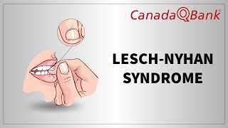 Lesch Nyhan Syndrome [upl. by Hakkeber]