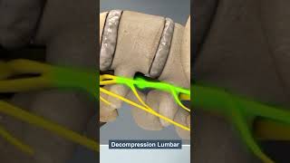 DECOMPRESSION LUMBAR THERAPY [upl. by Corry]