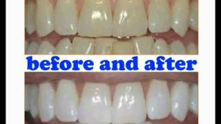 ❤FREE❤  How to Whiten Yellow Teeth at Home My Amazing Results [upl. by Didier]